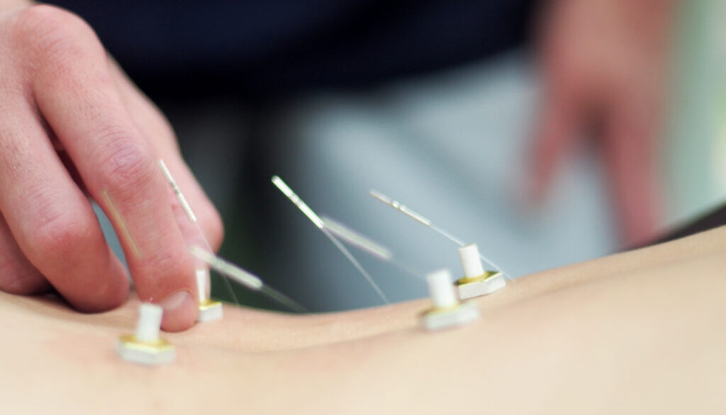 Woman receiving acupuncture and moxibustion